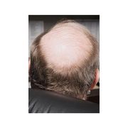 秃强还能再秃亿点